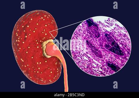 Acute Pyelonephritis, Illustration And Light Micrograph Stock Photo - Alamy