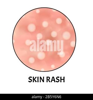 Skin rash. Symptom of dermatitis, allergies, psoriasis, eczema. Icons skin rash. Acne Infographics. Vector illustration on isolated background. Stock Vector