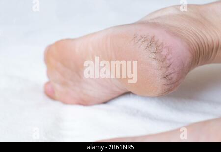 Dry cracked skin on the heels of a person s legs, close-up. The concept of serious diseases of the skin and thyroid gland Stock Photo