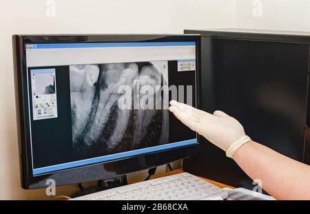 20 DECEMBER 2017, UFA, RUSSIA: Close-up Of A Dentist's Hand pointing On computer screen With Dental X-ray image of carious and damaged teethv Stock Photo