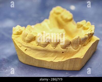 Teeth gypsum model. Dental care concept. Human teeth with dentures on 3d model Stock Photo