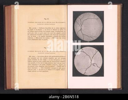 Fotoreproductie van twee anatomische tekeningen van onvoldoende doorbloeding in een oog Picture Reproduction of two anatomical drawings of insufficient blood circulation in a oog Object Type : photomechanical reproduction print page Object number: RP-F-2001-7-168-25 Inscriptions / Brands: inscription, recto, printed: 'Fig. 49. Ischemia brusque de la Retine épanchement sanguin par intravaginal Fig. 50. Ischemia brusque de la Retine épanchement sanguin par intravaginal' Manufacturer : manufacturer: anonymously to drawing of: anonymous date: ca. 1871 - in or in front 1891 Material: paper Techniqu Stock Photo