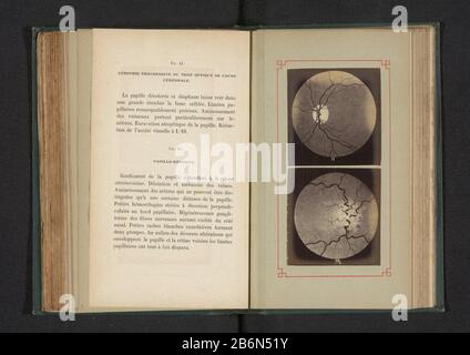 Fotoreproductie van twee anatomische tekeningen van progressieve atrofie van de oogzenuw en een ontsteking van een optische schijf Picture Reproduction of two anatomical drawings of progressive atrophy of the optic nerve and an ignition of an optical disk type of object: Object photo reproduction Page number: RP-F-2001-7-167-6 Inscriptions / Brands: inscription, recto, printed : 'Fig. 11. A progressive atrophy optique du nerf the cause cérébrale. Fig. 12. papillo-rétinite.' Manufacturer : photographer: anonymously to drawing of: anonymous date: ca. 1871 - in or in front 1881 Material: photo pa Stock Photo