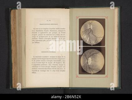 Fotoreproductie van twee anatomische tekeningen van een ontsteking van het vaatvlies in het oog Picture Reproduction of two anatomical drawings of an inflammation of the choroid in the oog Object Type : photo reproduction Page Object number: RP-F-2001-7-167-17 Inscriptions / Brands: inscription, recto, printed: 'Fig. 33. Chorio-rétinite spécifique. Fig. 34. Choroidite centrale.' Manufacturer : photographer: anonymously to drawing of: anonymous date: ca. 1871 - in or in front 1881 Material: photo paper Technique: albumin pressure dimensions: page: h 182 mm × W 110 mmToelichtingFoto's in the pho Stock Photo