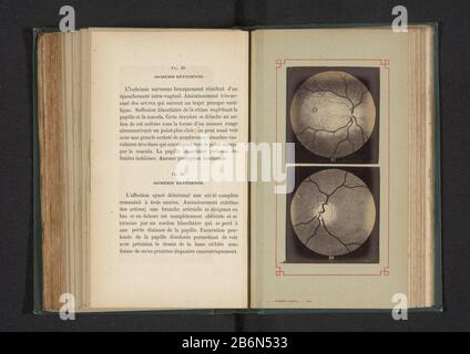 Fotoreproductie van twee anatomische tekeningen van onvoldoende doorbloeding in een oog Picture Reproduction of two anatomical drawings of insufficient blood circulation in a oog Object Type : photo reproduction Page Object number: RP-F-2001-7-167-10 Inscriptions / Brands: inscription, recto, printed: 'Fig. 19. Ischemia rétinienne. Fig. 20. Ischemia rétinienne.' Manufacturer : photographer: anonymously to drawing of: anonymous date: ca. 1871 - in or in front 1881 Material: photo paper Technique: albumin pressure dimensions: page: h 182 mm × W 110 mmToelichtingFoto's in the photo section achter Stock Photo