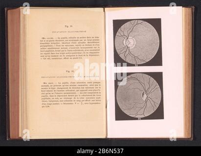 Fotoreproductie van twee anatomische tekeningen van een vervorming van een oog door glaucoom Picture Reproduction of two anatomical drawings of a deformation of an eye with glaucoma object type: photo-mechanical print reproduction page Object number: RP-F-2001-7-168-16 Inscriptions / Brands: inscription, recto, printed: 'Fig. 31. Excavation glaucomatous Fig. 32. Excavation glaucomatous avec hémorrhagie' Manufacturer : manufacturer: anonymously to drawing of: anonymous date: ca. 1871 - in or in front 1891 Material: paper Technique: light pressure dimensions: page: h 174 mm × W 105 mm Explanatio Stock Photo