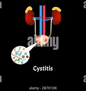 Cystitis. Inflammation of the bladder. The structure of the kidneys and bladder. Excretory system. Infographics. Vector illustration. Stock Vector
