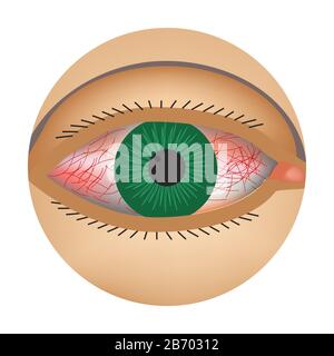 Redness of the eyes. Symptom of conjunctivitis, allergies, inflammation of the eyes. Eye redness icon. Infographics. Vector illustration on isolated Stock Vector
