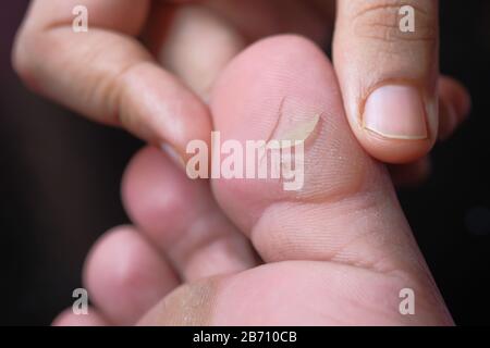 Close up of man suffering fit infection  Stock Photo