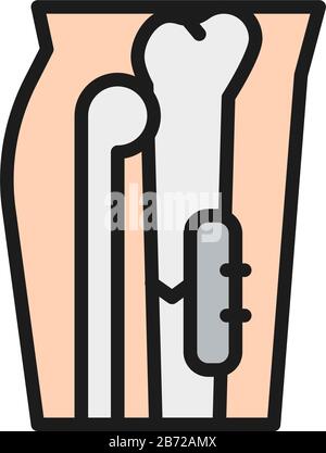 X-ray of broken leg, bone fixed with medical implantable plate flat color icon. Stock Vector