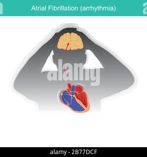 Atrial Fibrillation. Patients condition in which the electrical signals in heart malfunctioning or causing a short circuit in heart rhythm. Stock Vector