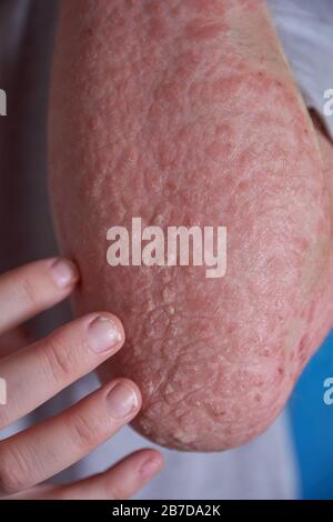 Forearm view of woman with Psoriasis Stock Photo