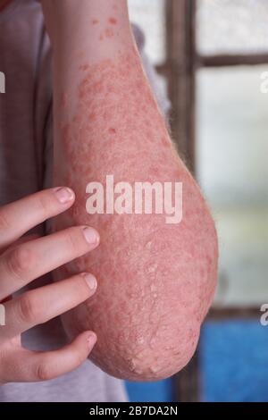 Forearm view of woman with Psoriasis Stock Photo