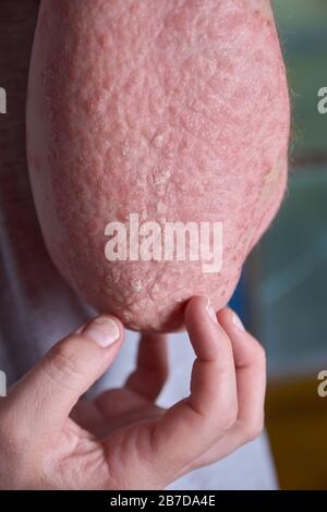 Forearm view of woman with Psoriasis Stock Photo