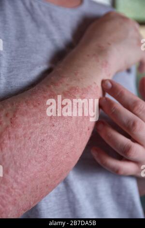 Forearm view of woman with Psoriasis Stock Photo