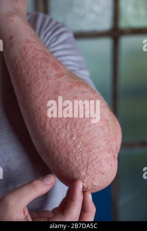 Forearm view of woman with Psoriasis Stock Photo