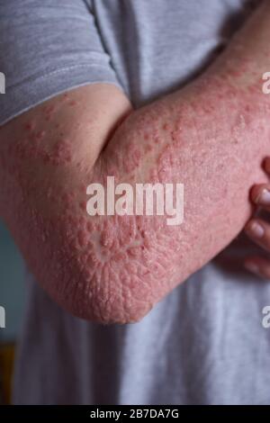 Forearm view of woman with Psoriasis Stock Photo