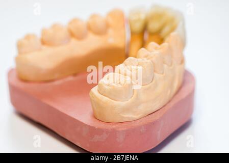 Dental gypsum model in dentist laboratory office - close-up.  Gypsum Dentures with porcelain teeth isolated on white background - copy space Stock Photo