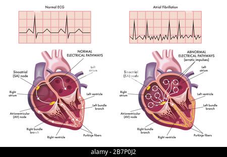 Medical illustration showing the symptoms of a heart with atrial fibrillation compared to normal one. Stock Photo