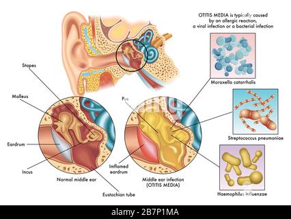 Medical illustration of the symptoms of otitis media. Stock Photo