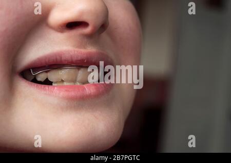 Defects of the jaw, crooked teeth in a child of 9 years, teeth requiring correction of the bite.Bite correction with orthodontic plate.  Close up Stock Photo