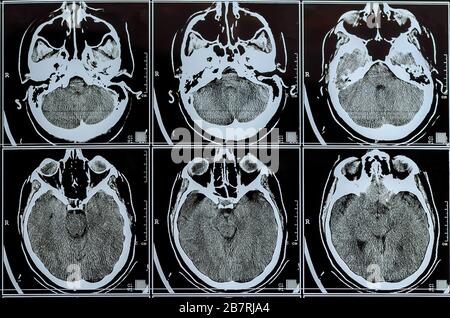 MRI scan of the brain. MRI brain scan or x-ray neurology