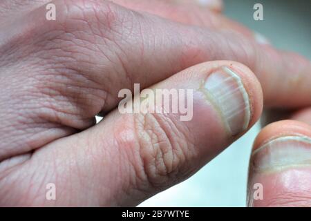Vertical ridges on the fingernails symptoms deficiency vitamins and minerals Stock Photo - Alamy Vertical ridges on the fingernails symptoms deficiency vitamins and minerals Stock Photo - Alamy