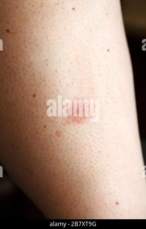 Redness around an insect bite. The bite has resulted in an allergic reaction (anaphylaxis). Stock Photo