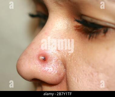 Inflamed pimple on nose. Cyst Acne. Acne on the skin Stock Photo