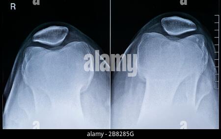 Human adult male right knee anatomy top view x-ray image. Radiography and medical imagery. Stock Photo