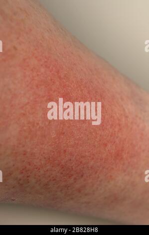 Manifestations of an allergic reaction to the sun. Photodermatitis caused by ultraviolet radiation