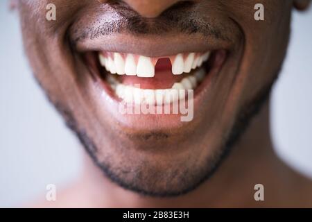 Close Up Photo Of Young Man With Missing Tooth Stock Photo