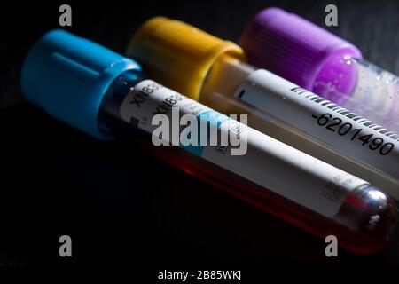 Test tube with  Coronavirus test blood sample . Laboratory testing patient’s blood Stock Photo