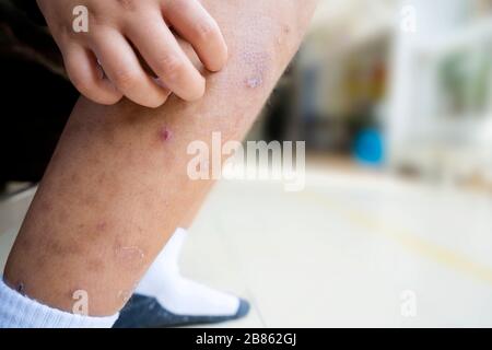 Little Asian boy has allergies with mosquitoes bite and itching her leg.Mosquito sucking blood on child skin. Many mosquito bites hurt and scars on th Stock Photo