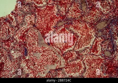 Pulmonary tuberculosis tissue under the microscope 200x Stock Photo