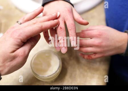 A mother is putting moisturizing lotion onto the hands of a child with severely dry and cracked skin. Stock Photo
