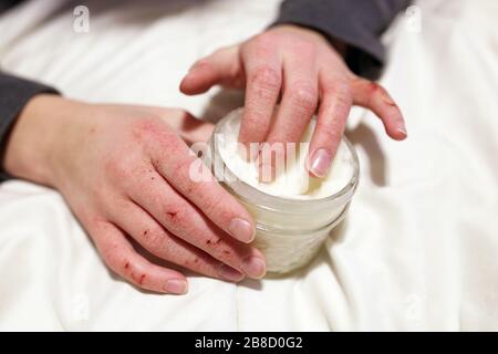 A young child is applying moisturizing lotion to his extremely cracked and dry skin on his hands. Stock Photo
