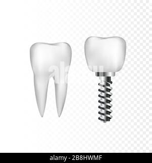 Healthy white tooth and implant with steel screw. Dentistry and dentist care. Vector illustration isolated on transparent background Stock Vector
