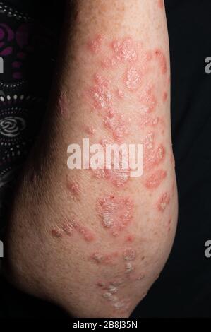 Inflamed psoriatic plaques on the white skin of the woman's forearm on a black background Stock Photo