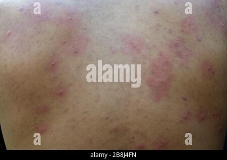 Asian teen boy Inflammatory acne on the back Stock Photo