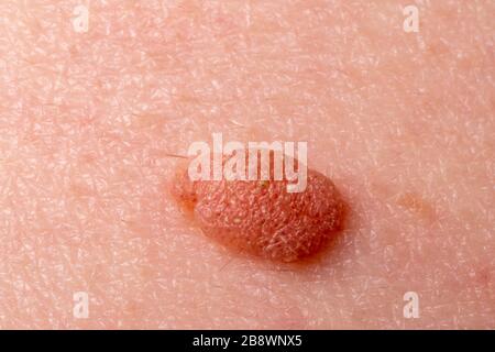 Large mole close-up. Macro shot of benign skin lesion on caucasian, human skin. Proliferation of pigment derma cells, melanocytic pigmented nevus Stock Photo