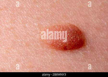 Large mole close-up. Macro shot of benign skin lesion on caucasian, human skin. Proliferation of pigment derma cells, melanocytic pigmented nevus Stock Photo