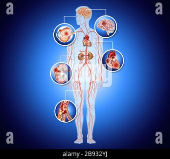 Hypertension complications Stock Photo - Alamy