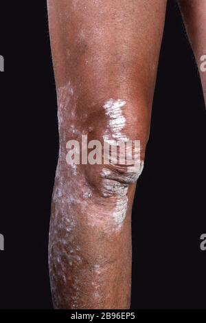 skin diseases - psoriasis on the legs Stock Photo