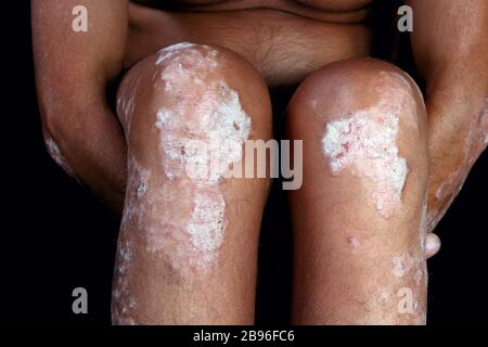 skin diseases - psoriasis on the legs Stock Photo