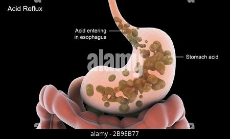 Biomedical illustration of acid reflux in the stomach. Stock Photo