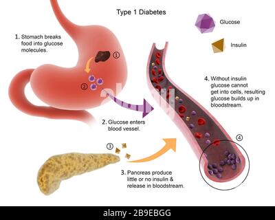 Human pancreas with diabetes Mellitus type 1 showing acin, and islets