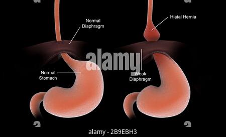 A healthy human stomach compared to an unhealthy human stomach with hiatal hernia. Stock Photo