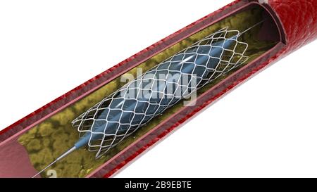 Cross-section of artery showing angioplasty and stent deployment. Stock Photo