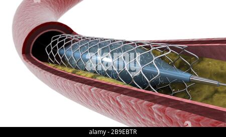Cross-section of artery showing angioplasty and stent deployment. Stock Photo